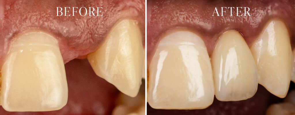 Before and After of dental Implant