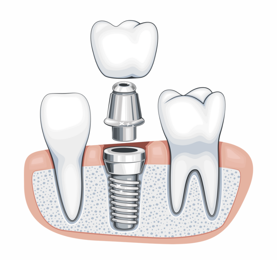 A Graphic showing the detailed components of dental implants.