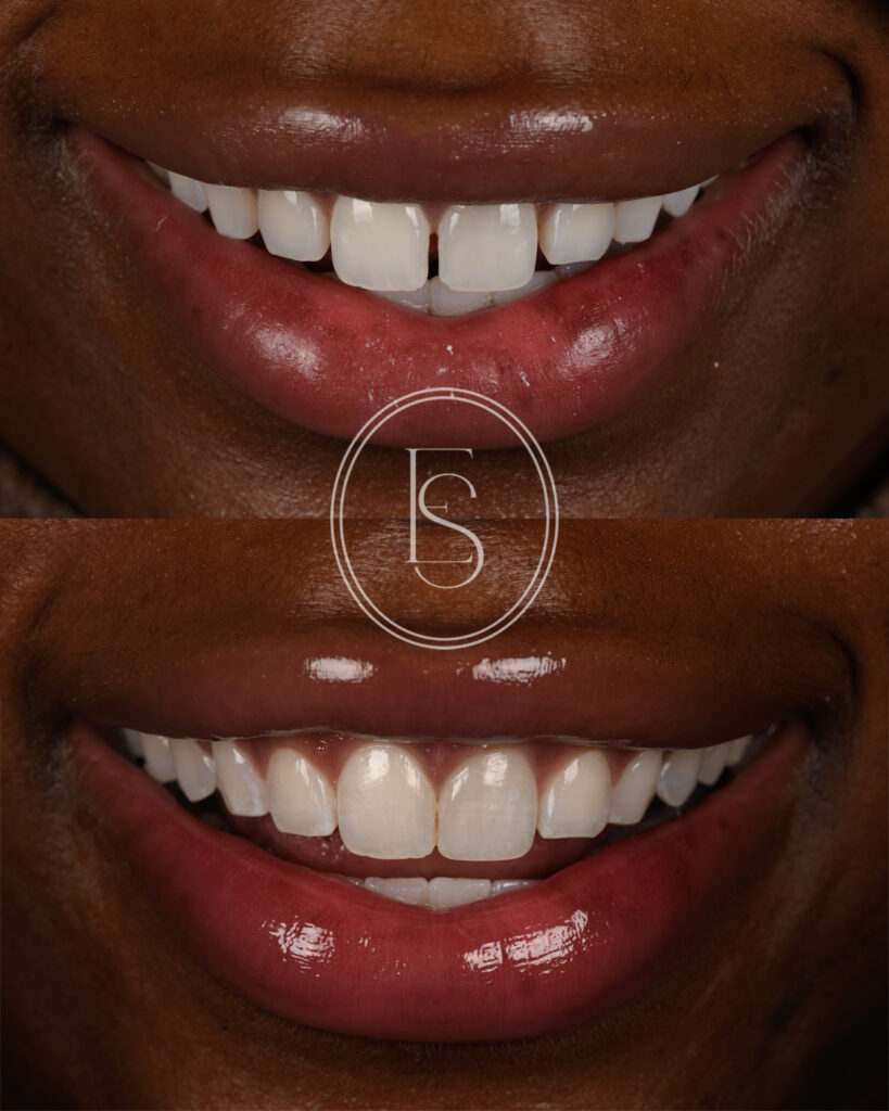 Before and After of Invisalign Treatment.